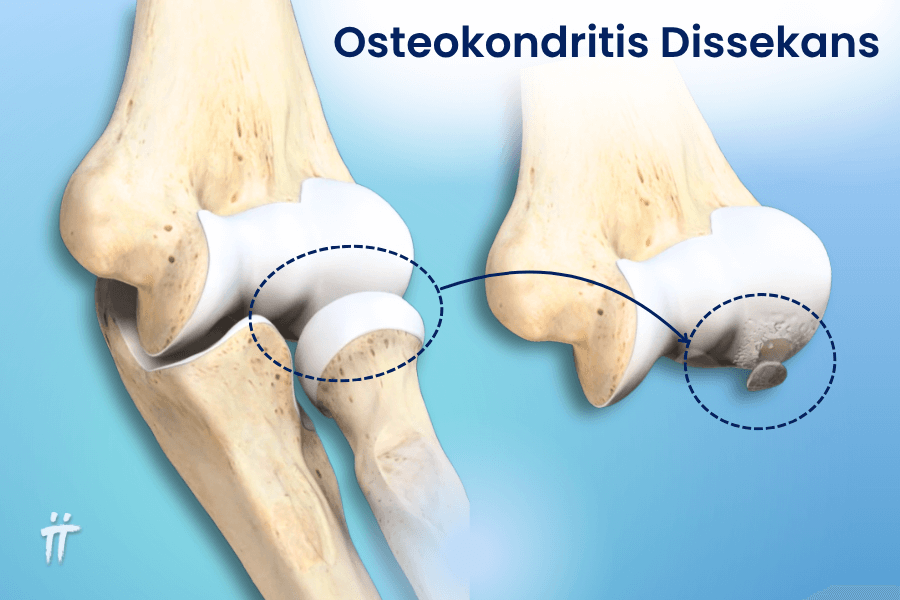 Eklem kıkırdağının altındaki kemiğin kan akışını kaybetmesiyle oluşan osteokondritis dissekans, dirsek ağrısı nedenleri arasında yer alır.