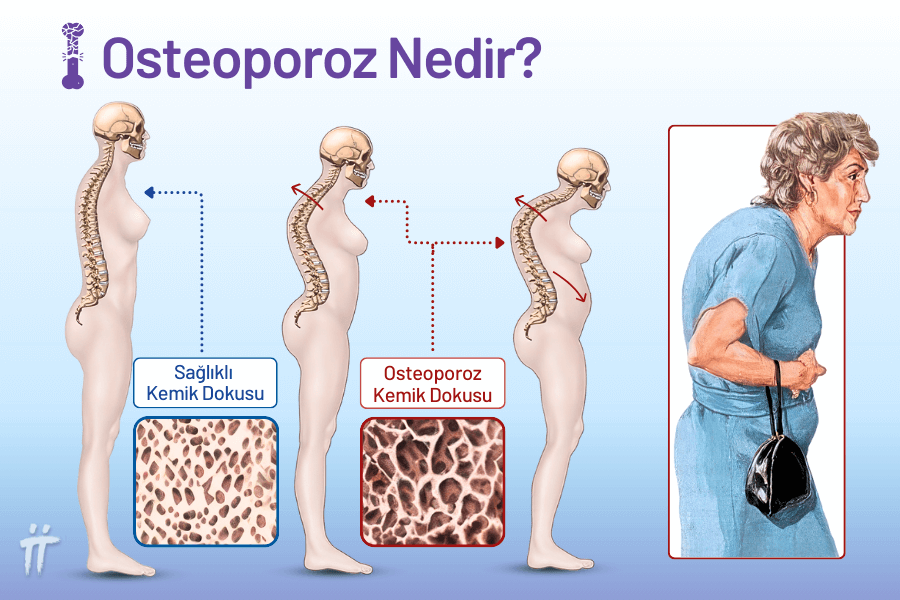 osteoporoz nedir