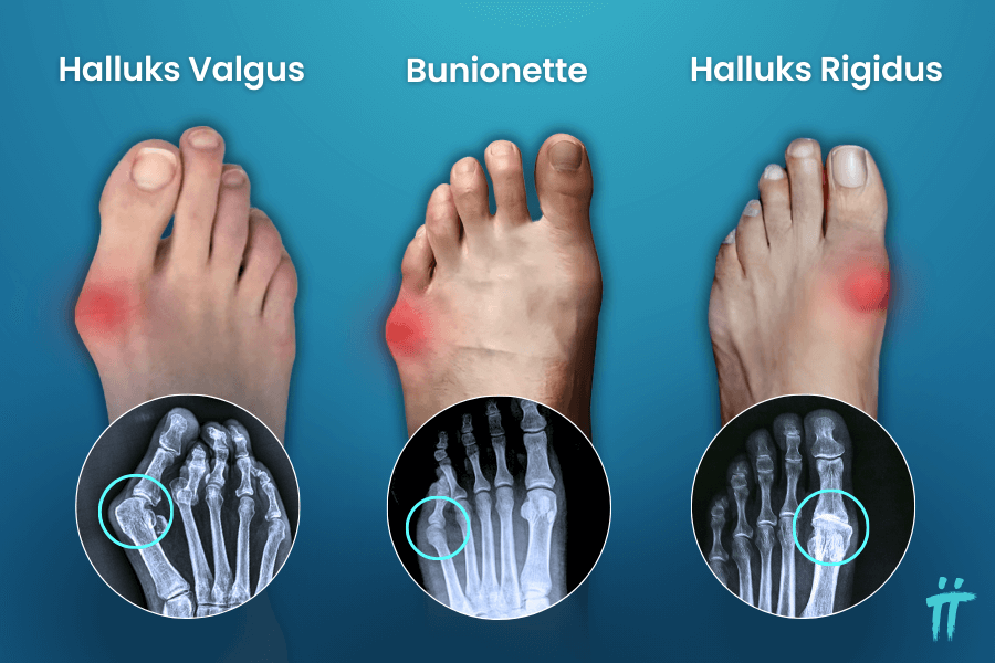 perkütan yöntemin uygulanabildiği ayak hastalıkları - Halluks Valgus, Buniontte , Halluks Rigidus