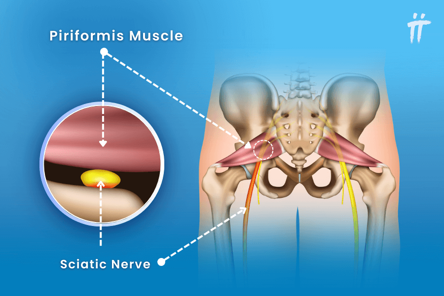 Piriformis Syndrome and sciatic nerve