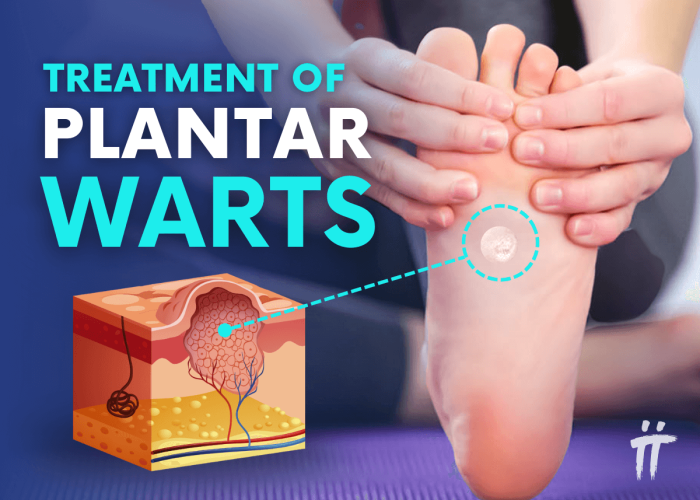 Plantar Warts: Treatments & Removal - Turan&Turan