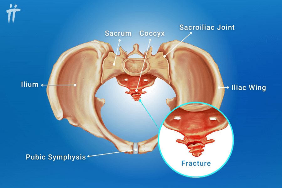 coccyx tailbone pain during pregnancy