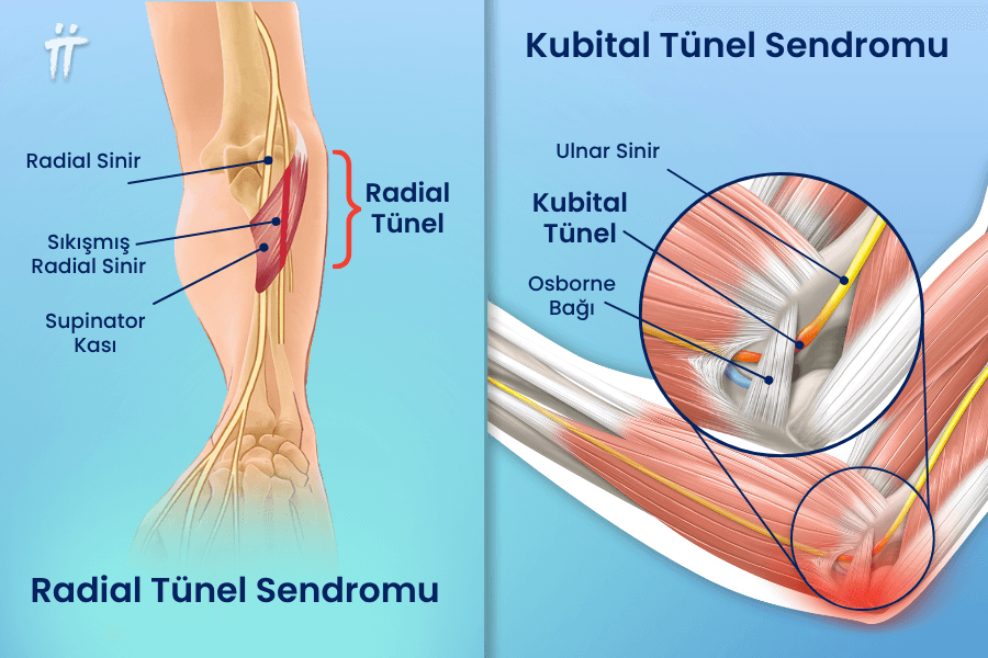 Dirsekteki sinirlerin geçtiği kanallarda baskı altında kalması, dirsek içi ağrı ve uyuşmaya yol açan kubital tünel sendromu ve dış tarafta ağrı yapan radial tünel sendromu gibi sorunlara neden olabilir.