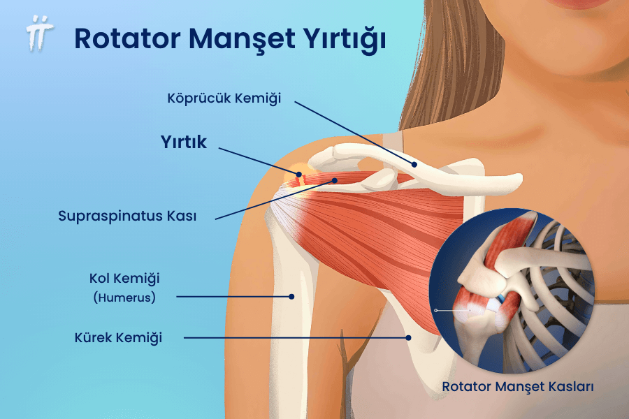 Rotator cuff yırtığı (rotator manşet yırtığı) omuz ve kol ağrısına neden olabilir. 