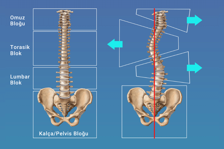 Schroth Metodu`na göre vücut blokları (sol), skolyoz varlığında santral sakral hatta göre vücut bloklarının yer değiştirmesi (sağ) 