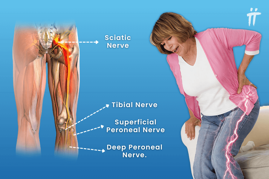 What is the sciatic nerve, where is it