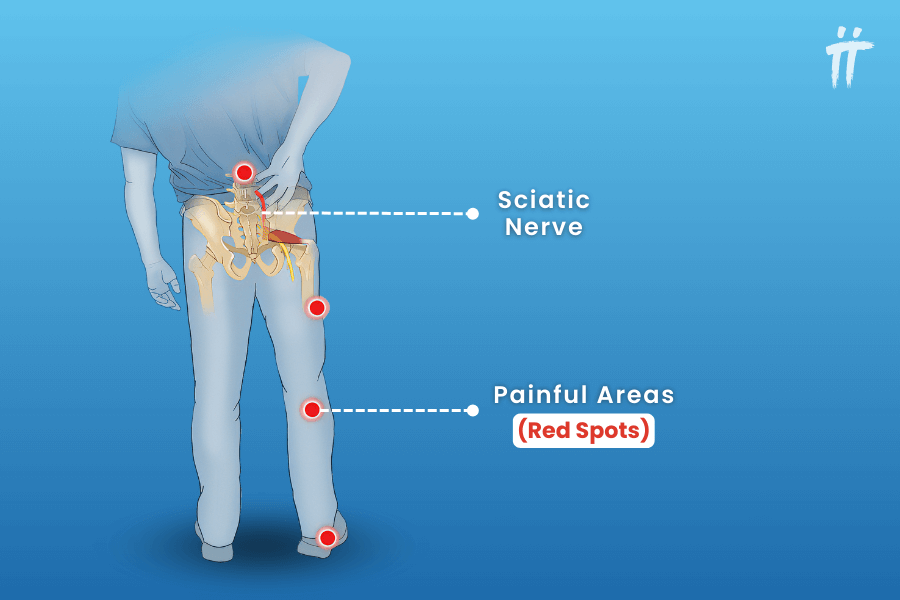 Areas where sciatica pain is seen