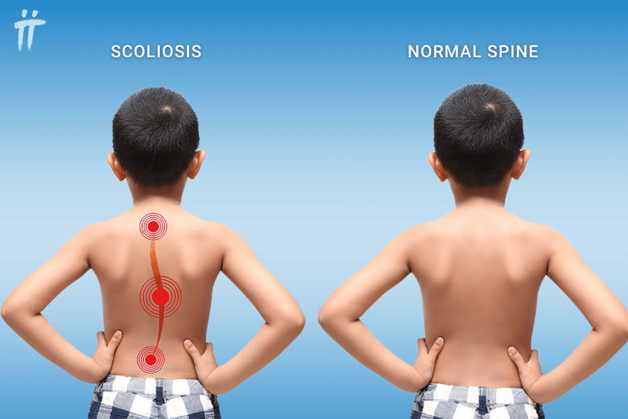 symptoms of scoliosis in children