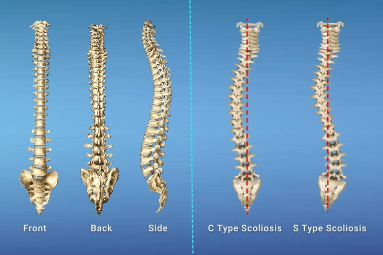 Scoliosis Exercises and Schroth Method Turan&Turan