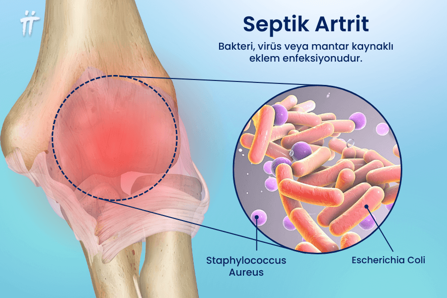 Mikroorganizmaların ekleme yerleşmesiyle oluşan ve acil tıbbi müdahale gerektiren septik artrit, dirsekte oluştuğunda şiddetli bir sağ veya sol kol dirsek ağrısı yaratabilir.