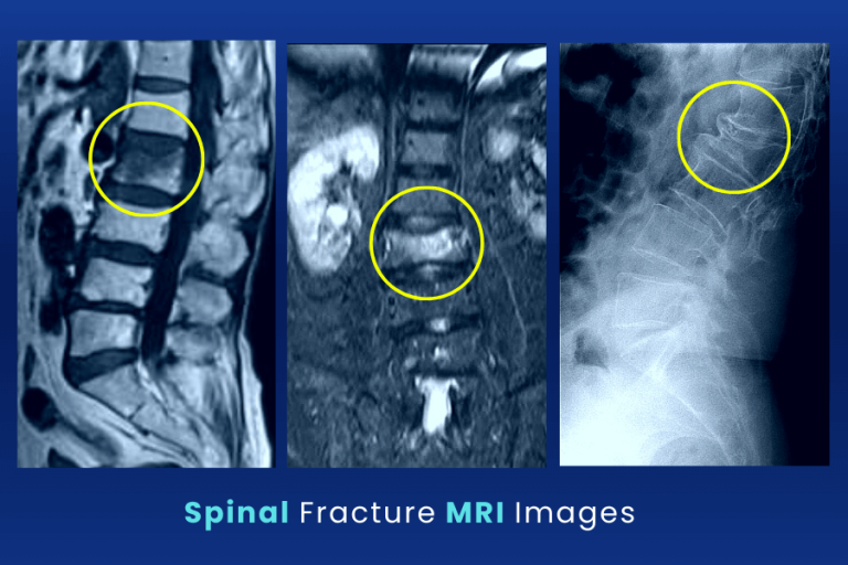 Spine Fractures and Spine Fracture Surgery Turan&Turan