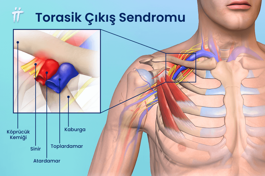 Torasik çıkış sendromu, sinir ve damar sıkışmasına bağlı olarak kol ağrısı yapabilir.