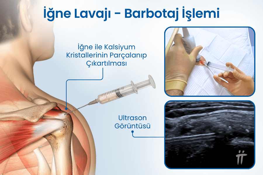 Kalsifik Tendinit Enjeksiyon Nedir?
