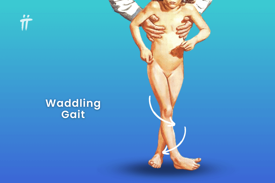 waddling gait disorder