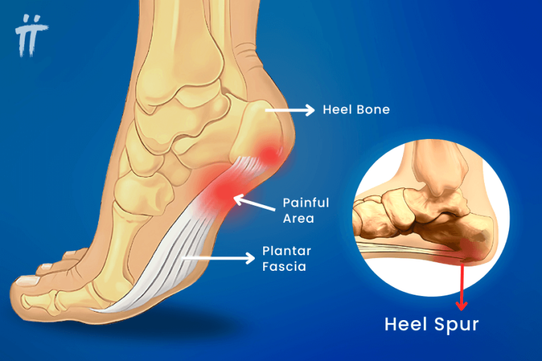 What is Heel Spur: Symptoms, Diagnosis and Treatment - Turan&Turan