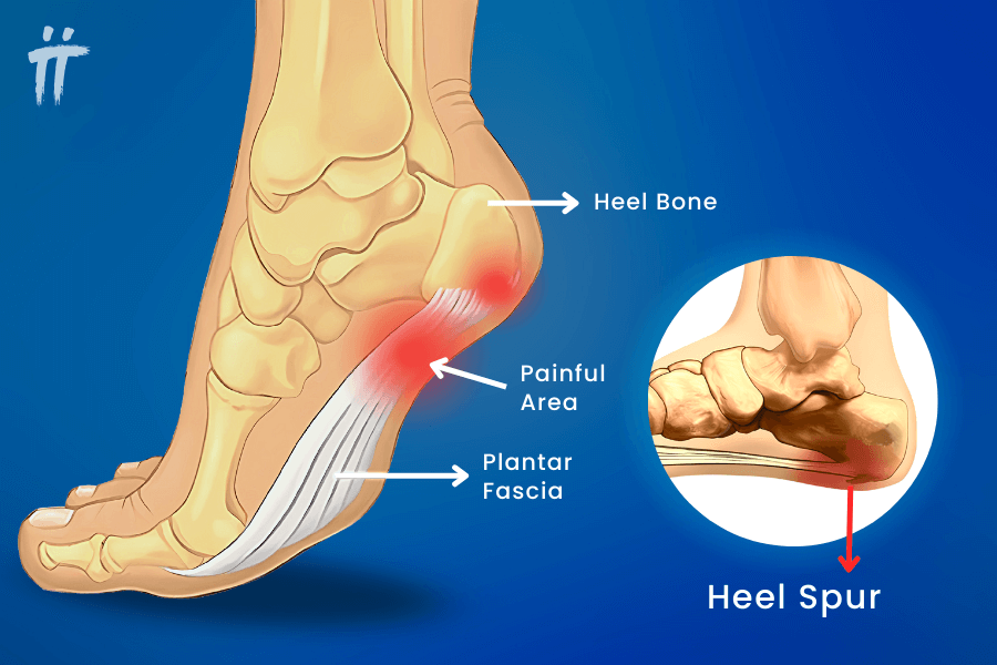 pain in heel spur