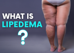what is lipedema