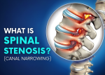 What is spinal stenosis canal narrowing