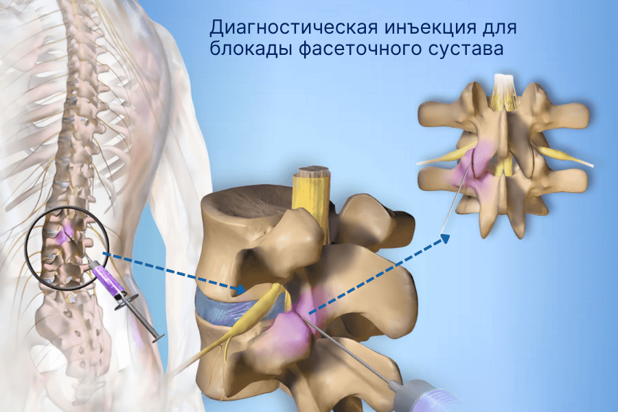 Диагностическая инъекция блокады фасеточного сустава