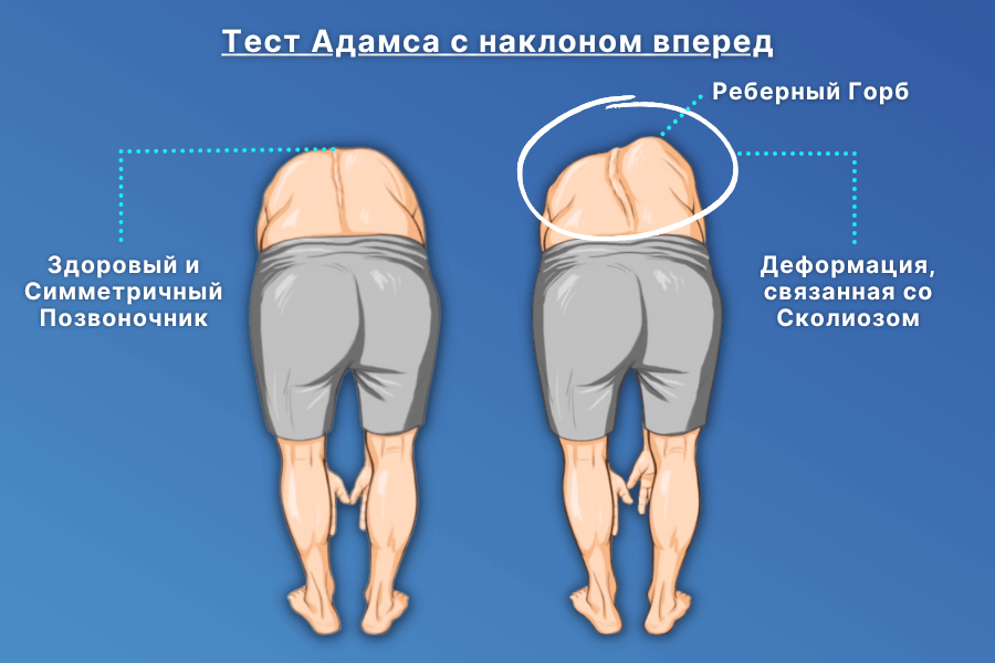 Разница в высоте между правой и левой областями спины во время теста (деформация горба)