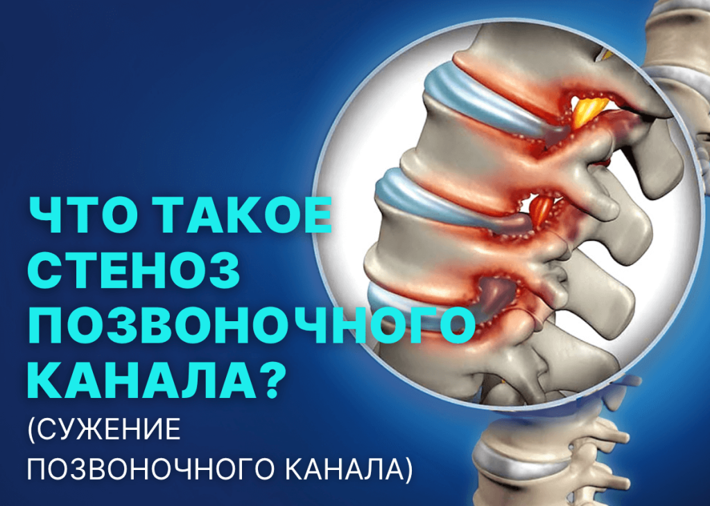 Что такое спинальный стеноз