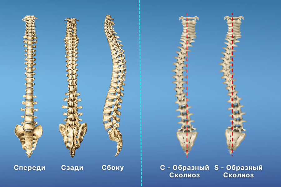 Слева: Вид спереди, сзади и сбоку здорового позвоночника соответственно -ПРАВО: С- или S-образный сколиоз